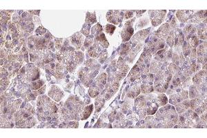 ABIN6273228 at 1/100 staining Human pancreas cancer tissue by IHC-P.