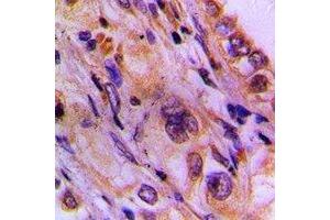 Immunohistochemical analysis of CEP78 staining in human lung cancer formalin fixed paraffin embedded tissue section. (CEP78 antibody)
