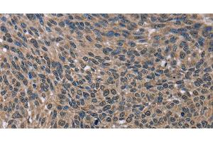 Immunohistochemistry of paraffin-embedded Human lung cancer using IMPDH2 Polyclonal Antibody at dilution of 1:60 (IMPDH2 antibody)
