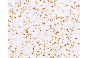 IHC testing of FFPE human bladder carcinoma with Topoisomerase II alpha antibody (clone TPM2A-2). (Topoisomerase II alpha antibody)