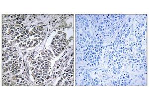 Immunohistochemistry analysis of paraffin-embedded human lung carcinoma tissue using ATP5D antibody.