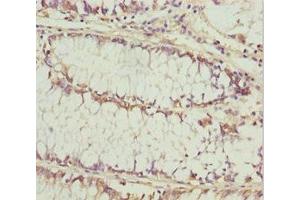 Immunohistochemistry of paraffin-embedded human colon cancer using ABIN7157472 at dilution of 1:100 (KERA antibody  (AA 21-352))