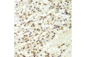 Immunohistochemistry of paraffin-embedded human kidney cancer using LHX4 antibody at dilution of 1:100 (x400 lens). (LHX4 antibody)