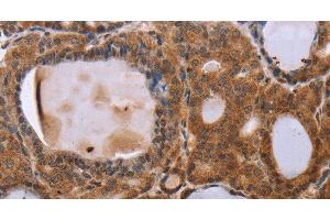 Immunohistochemistry of paraffin-embedded Human thyroid cancer using NDUFA2 Polyclonal Antibody at dilution of 1:30 (NDUFA2 antibody)