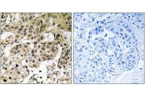 Immunohistochemistry analysis of paraffin-embedded human breast carcinoma, using HP1 alpha (Phospho-Ser92) Antibody.