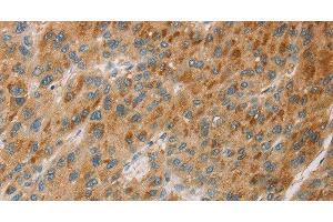 Immunohistochemistry of paraffin-embedded Human liver cancer tissue using CYP11B1 Polyclonal Antibody at dilution 1:30 (CYP11B1 antibody)