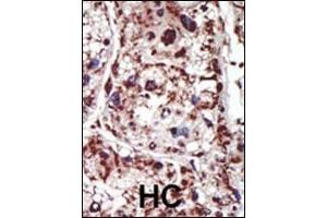 Formalin-fixed and paraffin-embedded human cancer tissue reacted with the primary antibody, which was peroxidase-conjugated to the secondary antibody, followed by DAB staining. (PACSIN1 antibody  (AA 8-38))