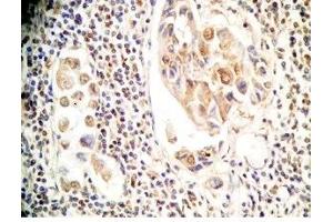 Human stomach cancer  tissue was stained by Rabbit Anti-Xenin 25 (Human) Antibody (Xenin 25 antibody)