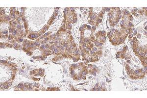 ABIN6279468 at 1/100 staining Human liver cancer tissue by IHC-P. (GNG12 antibody)