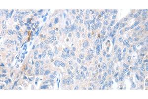 Immunohistochemistry of paraffin-embedded Human ovarian cancer using MAGEB4 Polyclonal Antibody at dilution of 1:40 (MAGEB4 antibody)