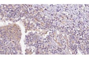 ABIN6273153 at 1/100 staining Human lymph cancer tissue by IHC-P.