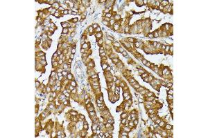 Immunohistochemistry of paraffin-embedded human thyroid cancer using COX15 antibody (ABIN7266634) at dilution of 1:100 (40x lens). (COX15 antibody  (AA 150-250))