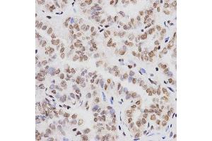 Immunohistochemistry of paraffin-embedded human thyroid cancer tissue using H3K4me1 antibody at dilution of 1:200 (x401 lens). (Histone 3 antibody  (H3K4me))