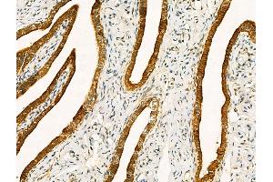 ABIN6261209 and ABIN6268652 at 1/100 staining Human ovarian cancer and adjacent normal tissues by IHC-P. (Cytokeratin 19 antibody  (C-Term))