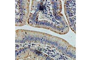 Immunohistochemical analysis of GLUD1 staining in human colon cancer formalin fixed paraffin embedded tissue section. (GLUD1 antibody)