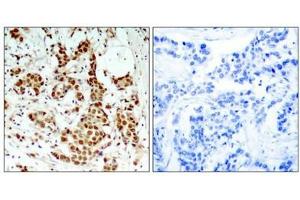 Immunohistochemical analysis of paraffin-embedded human breast carcinoma tissue using p90RSK(Phospho-Thr348) Antibody(left) or the same antibody preincubated with blocking peptide(right). (RPS6KA1 antibody  (pThr348))