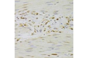 Immunohistochemistry of paraffin-embedded human gastric cancer using PRPF3 Antibody (ABIN5973192) at dilution of 1/100 (40x lens). (PRPF3 antibody)