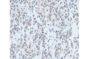 Immunohistochemistry of paraffin-embedded Human gastric cancer using ZNF703 Polyclonal Antibody at dilution of 1:100 (40x lens).