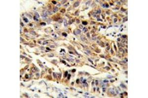 Immunohistochemistry analysis in human lung carcinoma (Formalin-fixed, Paraffin-embedded) using Fibulin-3 Antibody (N-term), followed by peroxidase-conjugated  secondary antibodyand DAB staining.