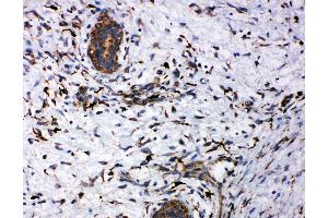 Anti-CD163 antibody,  IHC(P) IHC(P): Human Mammary Cancer Tissue