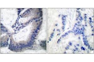 Immunohistochemistry analysis of paraffin-embedded human lung carcinoma tissue, using iNOS Antibody. (NOS2 antibody  (AA 1101-1150))