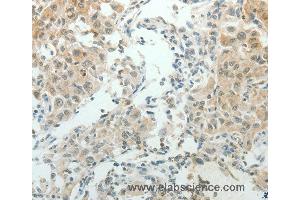 Immunohistochemistry of Human lung cancer using NDRG2 Polyclonal Antibody at dilution of 1:50