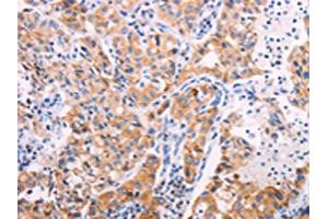 The image on the left is immunohistochemistry of paraffin-embedded Human lung cancer tissue using ABIN7131322(TEKT4 Antibody) at dilution 1/20, on the right is treated with fusion protein.