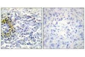 Immunohistochemistry analysis of paraffin-embedded human lung carcinoma tissue using FXR2 antibody. (FXR2 antibody)