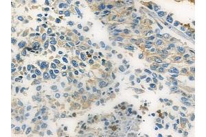 ABIN6257653 and ABIN6273822 at 1/100 staining human lung squamous cell carcinoma by IHC-P. (TRIB2 antibody  (N-Term))