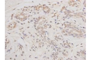 Paraformaldehyde-fixed, paraffin embedded human breast cancer, Antigen retrieval by boiling in sodium citrate buffer (pH6) for 15min, Block endogenous peroxidase by 3% hydrogen peroxide for 30 minutes, Blocking buffer (normal serum) at 37°C for 20min, Antibody incubation with BCL-2 (2C4) Monoclonal Antibody  at 1:50 overnight at 4°C, followed by a conjugated secondary and DAB staining. (Bcl-2 antibody)