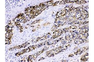 IHC testing of FFPE human esophageal SCC tissue with Cytokeratin 5 antibody at 1ug/ml. (Cytokeratin 5 antibody  (AA 286-317))