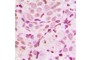 Immunohistochemical analysis of SRF (pS103) staining in human breast cancer formalin fixed paraffin embedded tissue section. (SRF antibody  (pSer103))