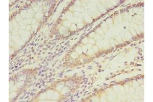 Immunohistochemistry of paraffin-embedded human colon cancer using ABIN7171437 at dilution of 1:100 (CCT6B antibody  (AA 101-330))