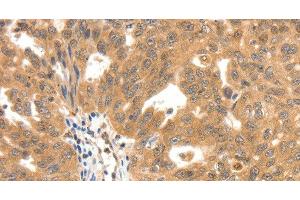 Immunohistochemistry of paraffin-embedded Human ovarian cancer tissue using SCN5A Polyclonal Antibody at dilution 1:30 (SCN5A antibody)