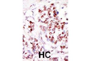 Formalin-fixed and paraffin-embedded human hepatocellular carcinoma tissue reacted with TLK1 polyclonal antibody  , which was peroxidase-conjugated to the secondary antibody, followed by DAB staining. (TLK1 antibody  (C-Term))