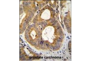 TR Antibody (N-term) (ABIN655614 and ABIN2845095) immunohistochemistry analysis in formalin fixed and paraffin embedded human prostate carcinoma followed by peroxidase conjugation of the secondary antibody and DAB staining. (TRPM8 antibody  (N-Term))