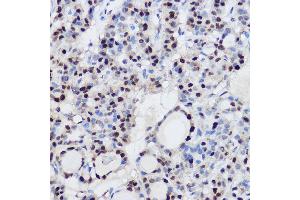 Immunohistochemistry of paraffin-embedded human thyroid cancer using EZH2/KMT6 Rabbit pAb (ABIN6133511, ABIN6140395, ABIN6140399 and ABIN6221414) at dilution of 1:100 (40x lens). (EZH2 antibody  (AA 1-250))