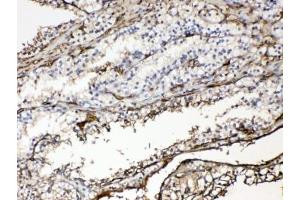 IHC testing of FFPE human renal cancer tissue with Hemoglobin antibody at 1ug/ml. (HBA1 antibody)