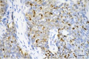 Immunohistochemistry was performed on paraffin-embedded human breast carcinoma using proliferating cell nuclear antigen antibody (ABIN7799914), 1:200).