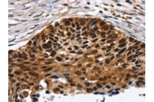 The image on the left is immunohistochemistry of paraffin-embedded Human esophagus cancer tissue using ABIN7192726(TACC2 Antibody) at dilution 1/30, on the right is treated with synthetic peptide. (TACC2 antibody)