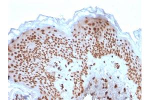 Formalin-fixed, paraffin-embedded human Basal Cell Carcinoma stained with Emerin Mouse Monoclonal Antibody (EMD/2167). (Emerin antibody  (AA 56-167))