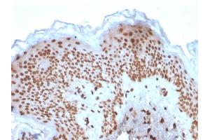 Formalin-fixed, paraffin-embedded human Basal Cell Carcinoma stained with Emerin Mouse Monoclonal Antibody (EMD/2167).