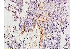 福尔马林固定和石蜡包埋的人食管癌，用抗IV型胶原多克隆抗体标记，1:200未结合，然后结合二级抗体和DAB染色（IV型胶原抗体（AA 1571-1669））