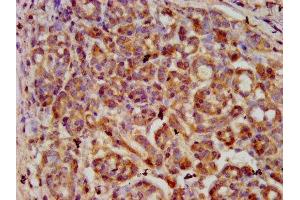 IHC image of ABIN7169341 diluted at 1:600 and staining in paraffin-embedded human pancreatic cancer performed on a Leica BondTM system. (SERPINB4 antibody  (AA 128-208))
