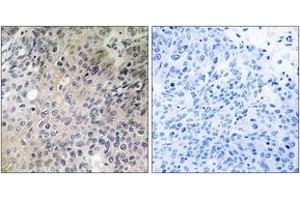 Immunohistochemistry analysis of paraffin-embedded human lung carcinoma tissue, using SHC3 Antibody. (SHC3 antibody  (AA 291-340))
