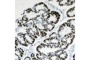 Immunohistochemical analysis of HBP1 staining in human colon cancer formalin fixed paraffin embedded tissue section. (HBP1 antibody  (C-Term))