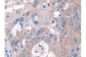 Detection of FUT6 in Human Breast cancer Tissue using Polyclonal Antibody to Fucosyltransferase 6 (FUT6) (FUT6 antibody  (AA 35-359))