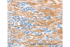 Immunohistochemistry of Human esophagus cancer using ALDOB Polyclonal Antibody at dilution of 1:40