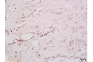 Formalin-fixed and paraffin embedded human cervical carcinoma labeled with Anti-Phospho-CHK2 (Thr68) Polyclonal Antibody, Unconjugated (ABIN703165) at 1:200 followed by conjugation to the secondary antibody and DAB staining (CHEK2 antibody  (pThr68))