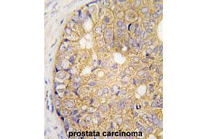 Formalin-fixed and paraffin-embedded human prostate carcinomareacted with GJB6 polyclonal antibody , which was peroxidase-conjugated to the secondary antibody, followed by AEC staining. (GJB6 antibody  (N-Term))